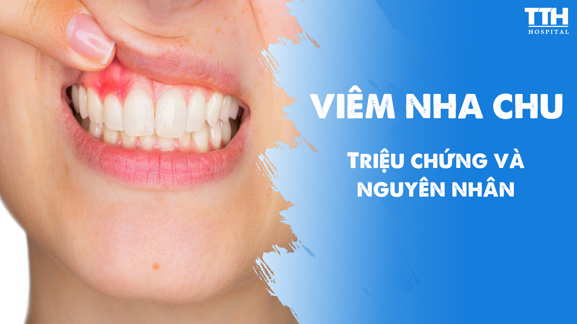 VIÊM NHA CHU - TRIỆU CHỨNG VÀ NGUYÊN NHÂN